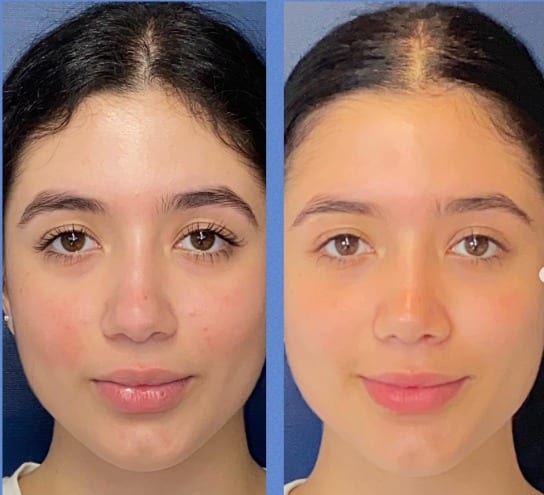 Rinoplastia caso 21 — antes y después